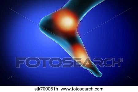 Conceptual image of muscle cramp and pain in human foot. View Large Illustration Drawing - Conceptual image of muscle cramp and pain in human foot.. Fotosearch