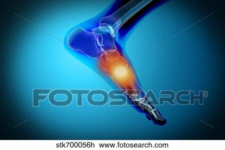 Conceptual image of pain in human foot. View Large Illustration Drawing - Conceptual image of pain in human foot.. Fotosearch