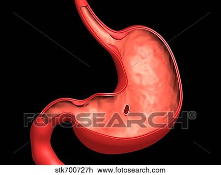 Drawing - Conceptual image of peptic ulcer in human stomach.. Fotosearch