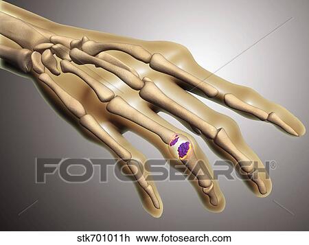 Drawing - Conceptual image of rheumatoid arthritis in the human hand.. Fotosearch
