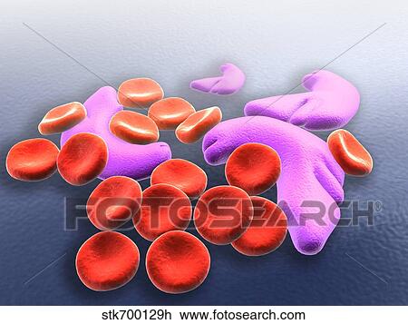 Drawing - Conceptual image of sickle cell anemia.. Fotosearch