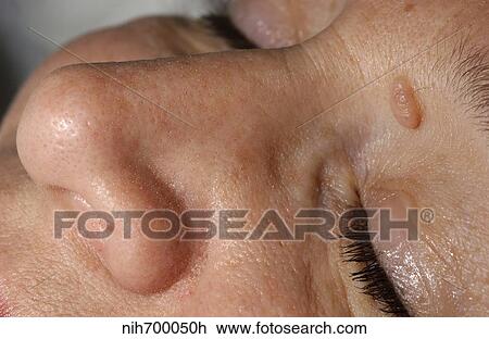 Dermal nevi are often elevated about the skin. View Large Photo Image Stock Image - Dermal nevi are often elevated about the skin.. Fotosearch