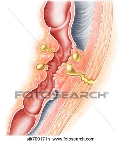 Drawing - Development of fistula.. Fotosearch