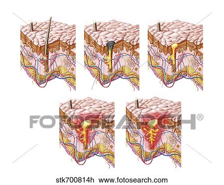 Drawing - Different types of acne, non-inflammatory and inflammatory.. Fotosearch