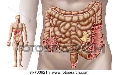 Diverticulitis in the descending colon region of the human intestine. View Large Illustration Drawing - Diverticulitis in the descending colon region of the human intestine.. Fotosearch