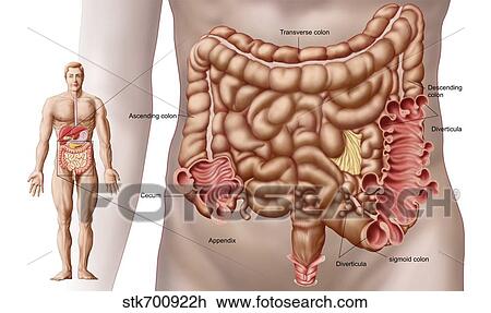 Diverticulitis in the descending colon region of the human intestine. View Large Illustration Drawing - Diverticulitis in the descending colon region of the human intestine.. Fotosearch