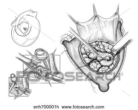 Drawing - Frontotemporal craniotomy for posterior communicating artery aneurysm clipping.. Fotosearch