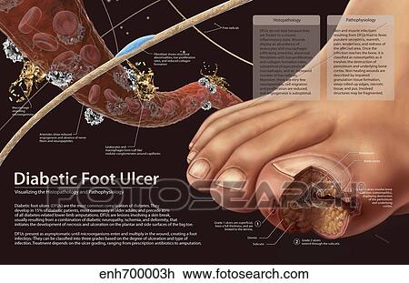Drawing - Histopathology and pathophysiology of diabetic food ulcers.. Fotosearch