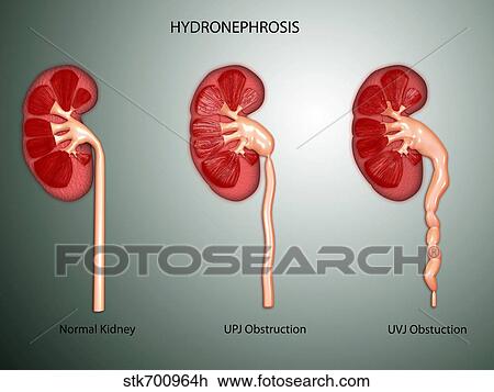 Drawing - Hydronephrosis condition of the kidney.. Fotosearch