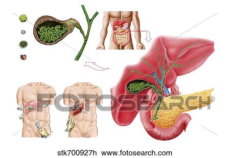 Illustration depicting cholecystectomy, the surgical removal of the gallbladder. View Large Illustration Drawing - Illustration depicting cholecystectomy, the surgical removal of the gallbladder.. Fotosearch