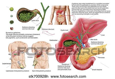 Illustration depicting cholecystectomy, the surgical removal of the gallbladder. View Large Illustration Drawing - Illustration depicting cholecystectomy, the surgical removal of the gallbladder.. Fotosearch