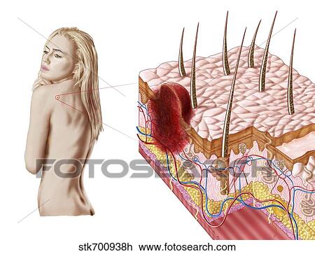Illustration of an atypical growth on the skin that could be a sign of skin cancer. View Large Illustration Drawing - Illustration of an atypical growth on the skin that could be a sign of skin cancer.. Fotosearch