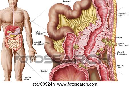 Illustration of diverticulosis in the colon. View Large Illustration Drawing - Illustration of diverticulosis in the colon.. Fotosearch