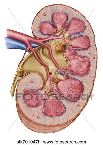 Large staghorn calculus in the human kidney. View Large Illustration Drawing - Large staghorn calculus in the human kidney.. Fotosearch