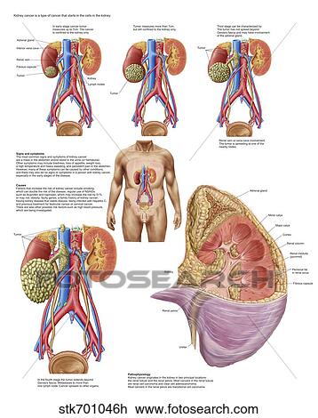 Drawing - Medical chart showing the signs and symptoms of kidney cancer.. Fotosearch