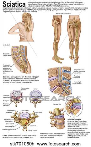 Medical chart showing the signs and symptoms of sciatica. View Large Illustration Drawing - Medical chart showing the signs and symptoms of sciatica.. Fotosearch