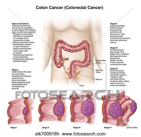 Drawing - Medical illustration depicting the different stages of colon cancer.. Fotosearch