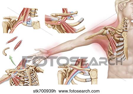 Drawing - Medical illustration detailing thoracic outlet syndrome.. Fotosearch