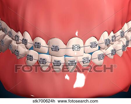 Medical illustration of human mouth showing teeth, gums and metal braces. View Large Illustration Drawing - Medical illustration of human mouth showing teeth, gums and metal braces.. Fotosearch