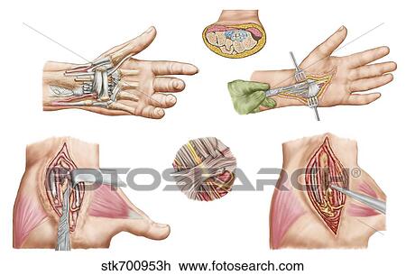 Medical illustration showing carpal tunnel syndrome in the human wrist. View Large Illustration Drawing - Medical illustration showing carpal tunnel syndrome in the human wrist.. Fotosearch