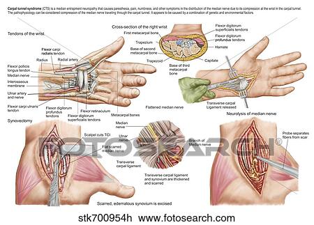 Medical illustration showing carpal tunnel syndrome in the human wrist. View Large Illustration Drawing - Medical illustration showing carpal tunnel syndrome in the human wrist.. Fotosearch