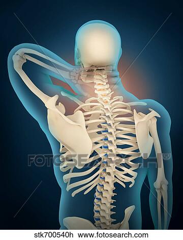 Medical illustration showing inflammation in human neck area View Large Illustration Drawing - Medical illustration showing inflammation in human neck area. Fotosearch