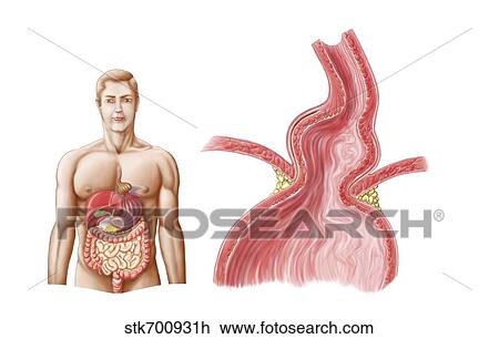 Medical ilustration of a hiatal hernia in the upper part of the stomach into the thorax. View Large Illustration Drawing - Medical ilustration of a hiatal hernia in the upper part of the stomach into the thorax.. Fotosearch
