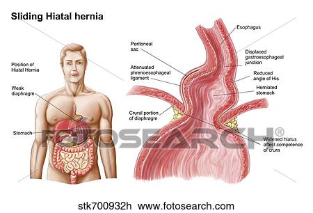 Medical ilustration of a hiatal hernia in the upper part of the stomach into the thorax. View Large Illustration Drawing - Medical ilustration of a hiatal hernia in the upper part of the stomach into the thorax.. Fotosearch