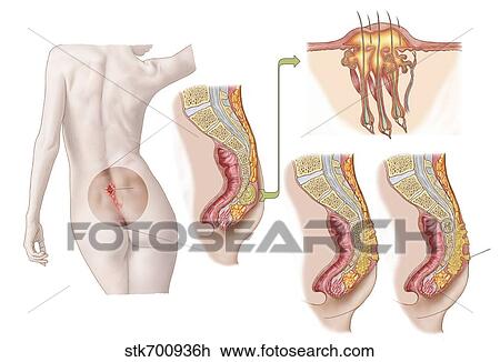 Drawing - Medical ilustration of a pilonidal cyst near the natal cleft of the buttocks.. Fotosearch