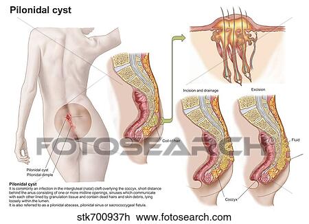Drawing - Medical ilustration of a pilonidal cyst near the natal cleft of the buttocks.. Fotosearch