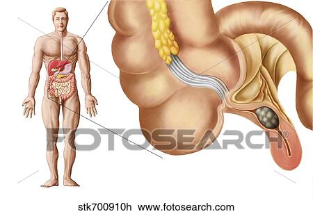 Drawing - Medical ilustration of an appendix with appendicitis.. Fotosearch