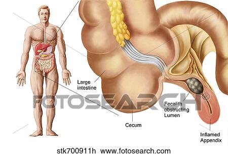 Medical ilustration of an appendix with appendicitis. View Large Illustration Drawing - Medical ilustration of an appendix with appendicitis.. Fotosearch