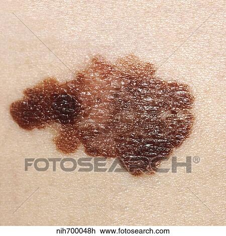 Melanoma on a patient's skin. View Large Photo Image Stock Image - Melanoma on a patient's skin.. Fotosearch