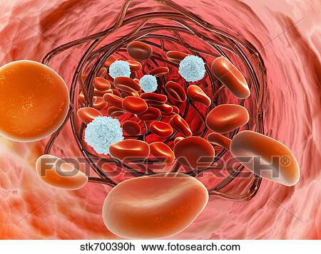 Drawing - Microscopic view of blood flow inside an artery with stent deployment.. Fotosearch