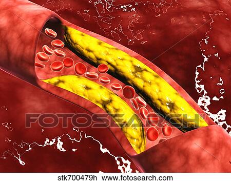 Drawing - Microscopic view of fat plaque inside the artery.. Fotosearch