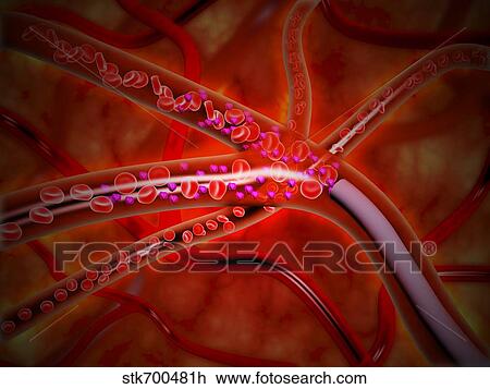 Drawing - Microscopic view of medicine being injected inside the artery.. Fotosearch