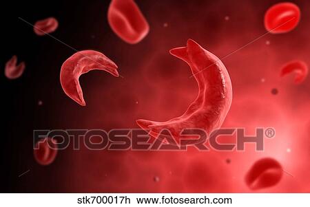 Drawing - Microscopic view of sicke cells causing anemia disease.. Fotosearch