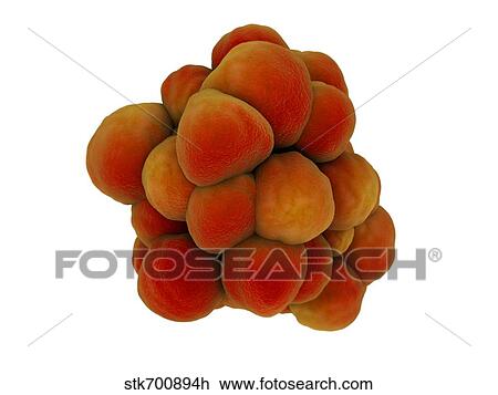 Drawing - Microscopic view of tumor.. Fotosearch