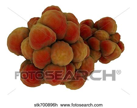 Drawing - Microscopic view of tumor.. Fotosearch