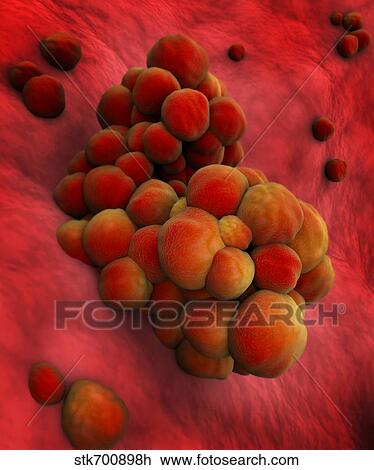 Drawing - Microscopic view of tumor.. Fotosearch