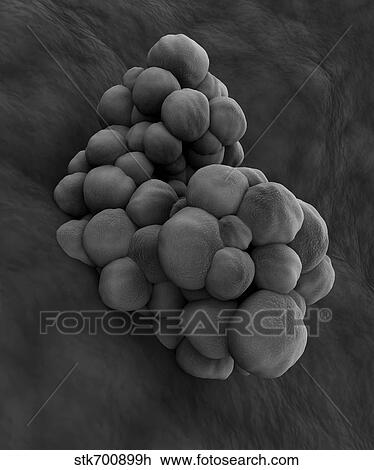 Drawing - Microscopic view of tumor.. Fotosearch