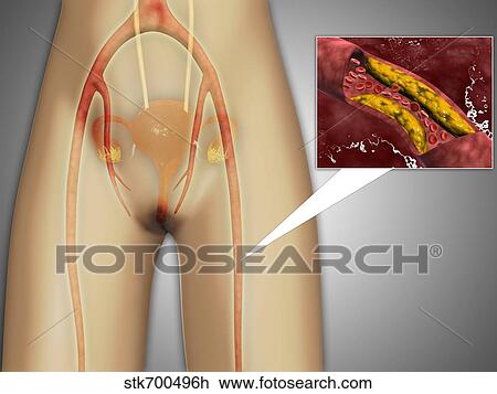 Drawing - Narrowed artery near leg with microscopic close-up.. Fotosearch