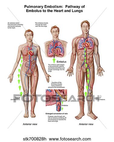 Pulmonary embolism, pathway of embolus to the heart and lungs. View Large Illustration Drawing - Pulmonary embolism, pathway of embolus to the heart and lungs.. Fotosearch