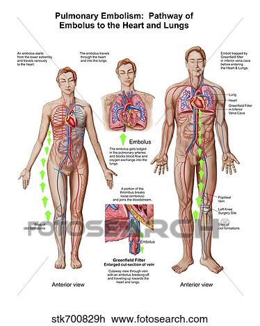 Drawing - Pulmonary embolism, pathway of embolus to the heart and lungs.. Fotosearch