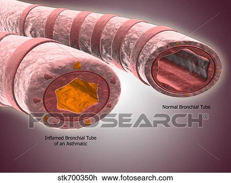 Trachea cross-section showing normal and asthmatic bronchiole. View Large Illustration Drawing - Trachea cross-section showing normal and asthmatic bronchiole.. Fotosearch