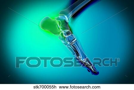 Drawing - X-ray view of pain in human foot.. Fotosearch