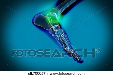 Drawing - X-ray view of pain in human foot.. Fotosearch