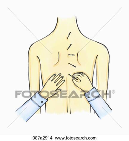 Illustration of a back with acupuncutre needles View Large Illustration Stock Illustration - Illustration of a back with acupuncutre needles. Fotosearch