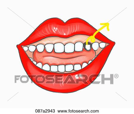 Illustration of a decayed teeth View Large Illustration Drawing - Illustration of a decayed teeth. Fotosearch