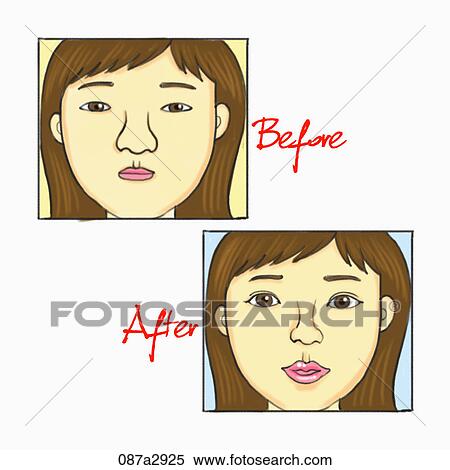 Illustration of before and after plastic surgery View Large Illustration Stock Illustration - Illustration of before and after plastic surgery. Fotosearch